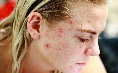 Kennisbank 89 Acne: wat is acne en wat kan je er tegen doen?