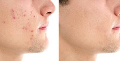 Kennisbank 87 Acne zelf behandelen? Behandel acne zelf op de juiste manier!