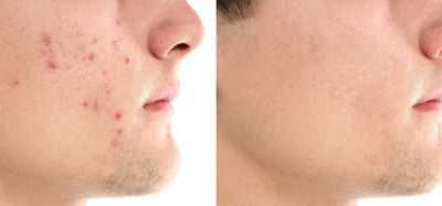 Kennisbank 66 Hoe kan ik puistjes en acne voorkomen en verhelpen?