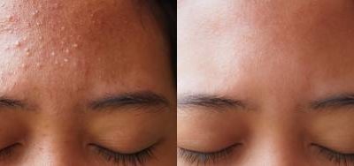 Kennisbank 81 Puistjes op je voorhoofd: via deze tips kom je er snel vanaf!