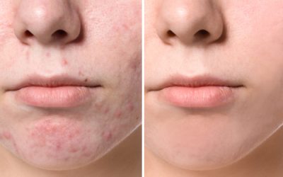 Kennisbank 56 De beste benzoylperoxide tegen puistjes en acne