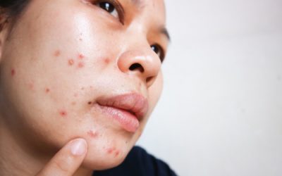 Kennisbank 53 De beste lotion tegen puistjes en acne