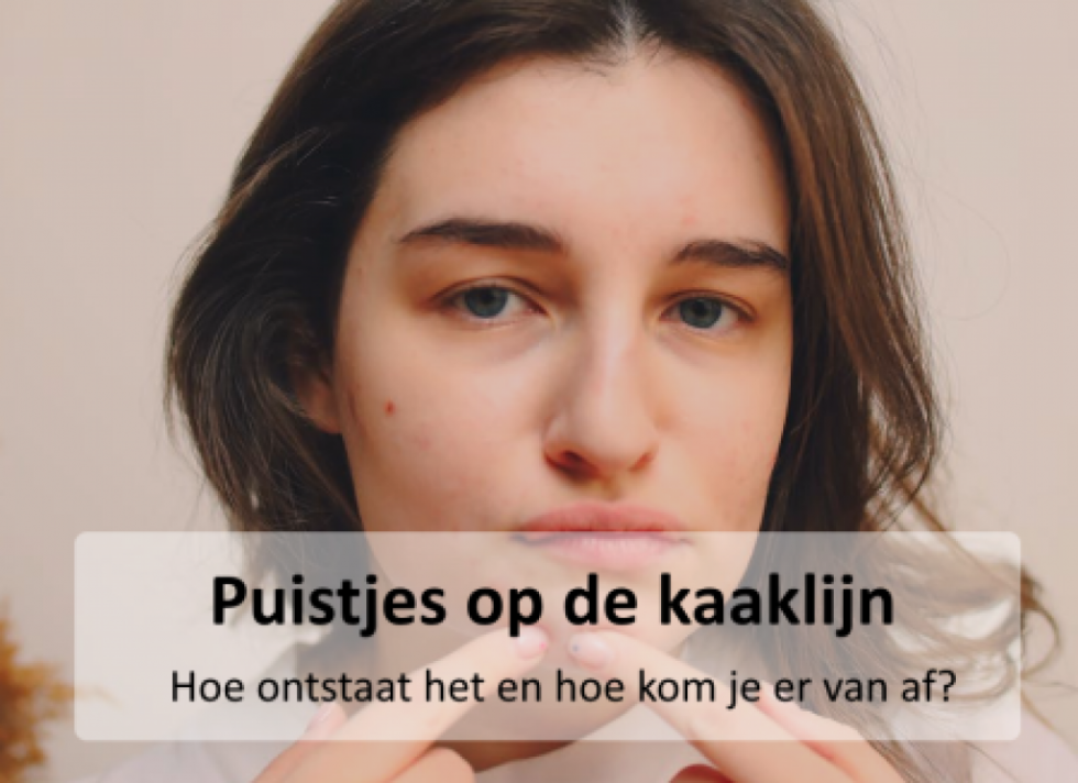 Puist op je kaaklijn en zoek je tips? Puist.nl!