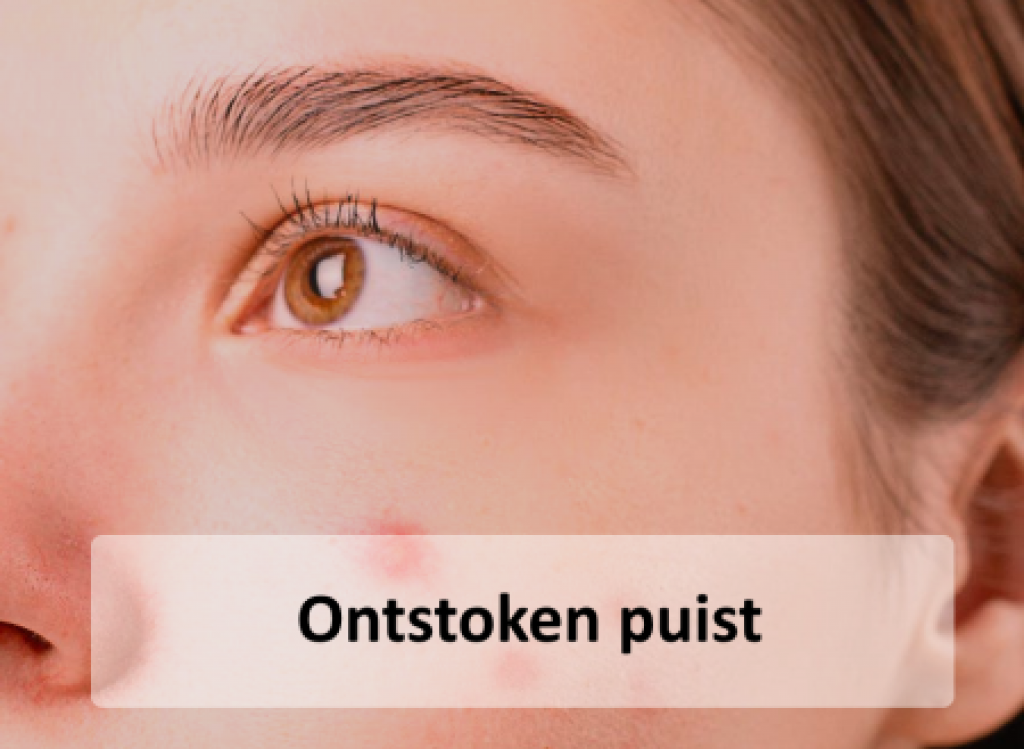 Heb je last van een ontstoken puist? Op Puist.nl helpen we jou er vanaf!