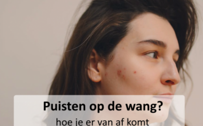 Kennisbank 43 Puistjes op de wangen? Hoe kom je er van af